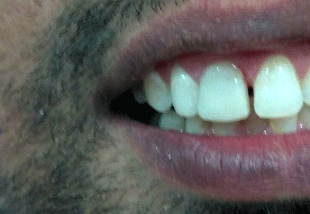 Dental Aesthetics