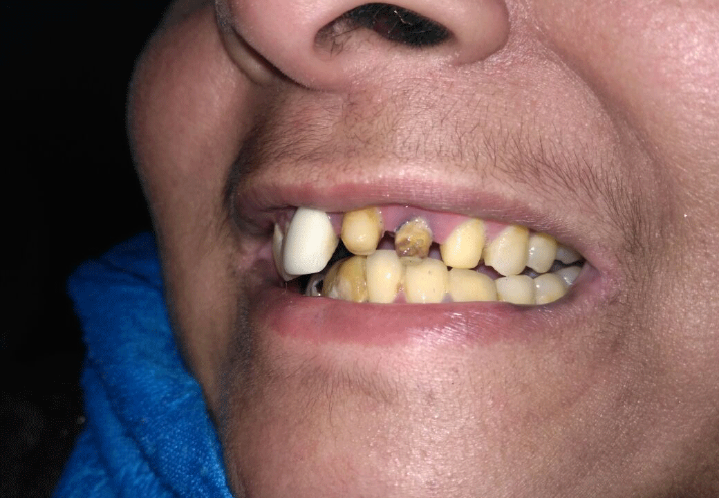 Dental Aesthetics