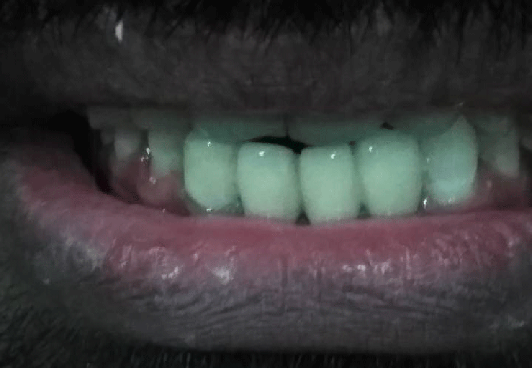 Dental Aesthetics