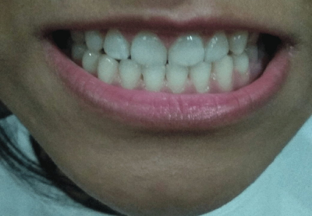 Dental Aesthetics