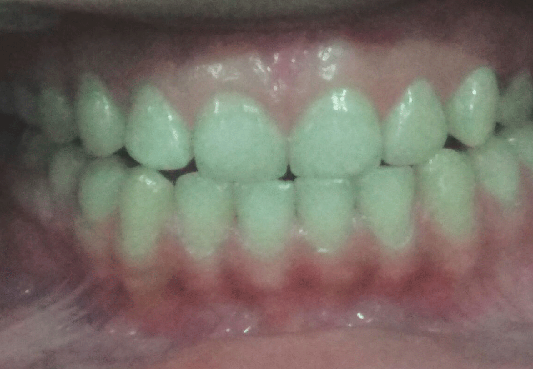 Dental Aesthetics