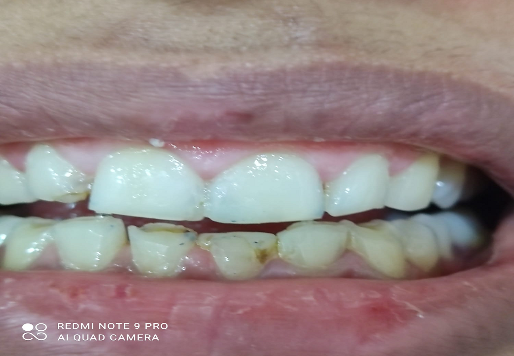 Dental Aesthetics