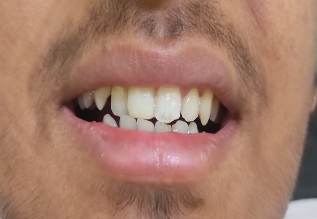Dental Aesthetics